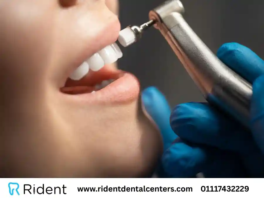 سعر تنظيف الاسنان